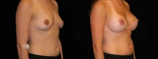 Before and after Breast Augmentation case 32674 - Angle 4