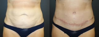 Before and after Tummy Tuck case 32675 - Angle 1