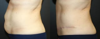 Before and after Tummy Tuck case 32675 - Angle 4