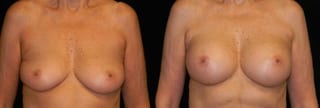 Before and after Breast Augmentation case 32677 - Angle 1