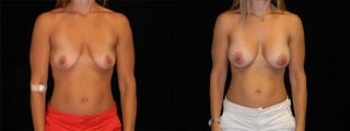 Before and after Breast Augmentation case 32676 - Angle 1