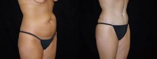 Before and after Tummy Tuck case 32680 - Angle 1
