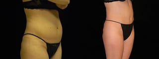Before and after Tummy Tuck case 32681 - Angle 1