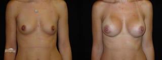 Before and after Breast Augmentation case 32679 - Angle 1