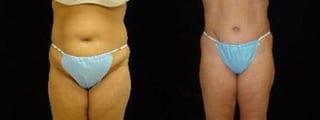 Before and after Tummy Tuck case 32682 - Angle 1