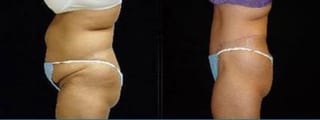 Before and after Tummy Tuck case 32682 - Angle 2