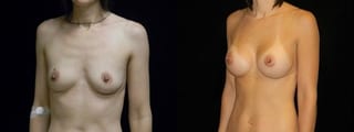 Before and after Breast Augmentation case 32683 - Angle 2