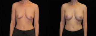 Before and after Breast Augmentation case 32684 - Angle 1