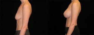 Before and after Breast Augmentation case 32684 - Angle 2