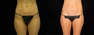 Before and after Tummy Tuck case 32687 - Angle 1