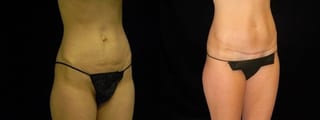 Before and after Tummy Tuck case 32687 - Angle 2