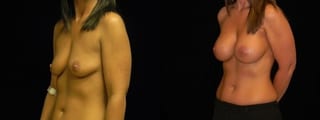 Before and after Breast Augmentation case 32686 - Angle 2