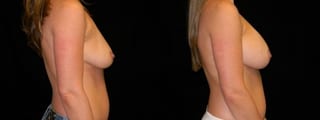 Before and after Breast Augmentation case 32688 - Angle 2