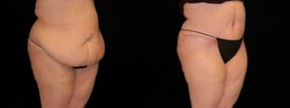 Before and after Tummy Tuck case 32689 - Angle 2