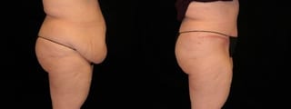 Before and after Tummy Tuck case 32689 - Angle 3