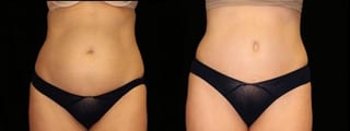 Before and after Tummy Tuck case 32691 - Angle 1