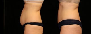 Before and after Tummy Tuck case 32691 - Angle 3