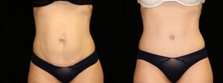 Before and after Tummy Tuck case 32692 - Angle 1