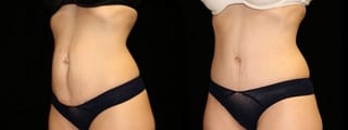 Before and after Tummy Tuck case 32692 - Angle 2
