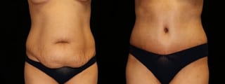 Before and after Tummy Tuck case 32693 - Angle 1