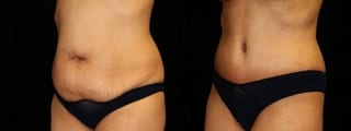 Before and after Tummy Tuck case 32693 - Angle 2