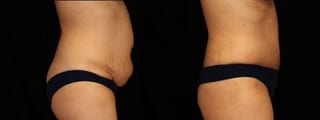 Before and after Tummy Tuck case 32693 - Angle 4