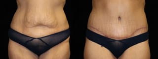 Before and after Tummy Tuck case 32694 - Angle 1