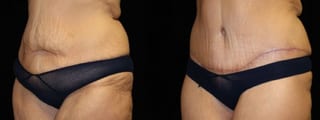 Before and after Tummy Tuck case 32694 - Angle 2