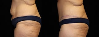 Before and after Tummy Tuck case 32694 - Angle 3