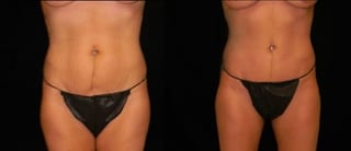 Before and after Tummy Tuck case 32695 - Angle 1