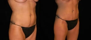 Before and after Tummy Tuck case 32695 - Angle 2
