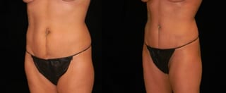 Before and after Tummy Tuck case 32695 - Angle 3