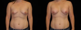 Before and after Breast Augmentation case 32698 - Angle 1