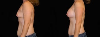 Before and after Breast Augmentation case 32698 - Angle 2