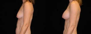 Before and after Breast Augmentation case 32697 - Angle 2