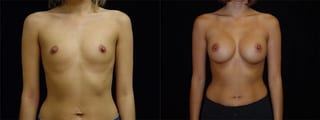 Before and after Breast Augmentation case 32700 - Angle 1