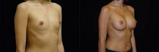 Before and after Breast Augmentation case 32700 - Angle 2