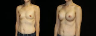 Before and after Breast Augmentation case 32701 - Angle 2