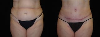 Before and after Tummy Tuck case 32702 - Angle 1