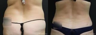 Before and after Liposuction case 32706 - Angle 1