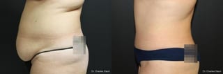 Before and after Liposuction case 32706 - Angle 2