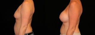 Before and after Breast Augmentation case 32704 - Angle 2