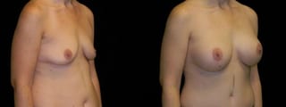 Before and after Breast Augmentation case 32707 - Angle 2