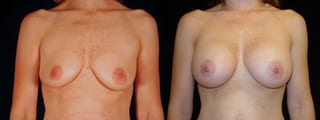 Before and after Breast Augmentation case 32709 - Angle 1