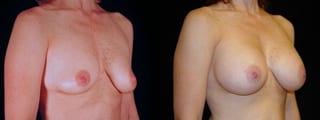 Before and after Breast Augmentation case 32709 - Angle 2