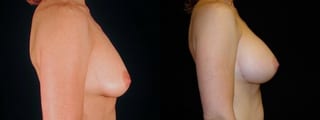 Before and after Breast Augmentation case 32709 - Angle 3