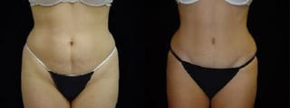 Before and after Tummy Tuck case 32710 - Angle 1