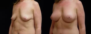 Before and after Breast Augmentation case 32711 - Angle 2