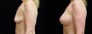 Before and after Breast Augmentation case 32711 - Angle 3