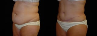 Before and after Tummy Tuck case 32712 - Angle 2